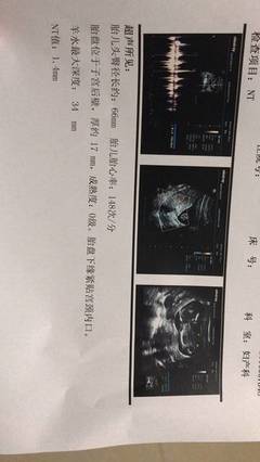 胎盘在右侧壁胎儿图片