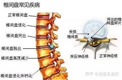 腰椎响是怎么回事