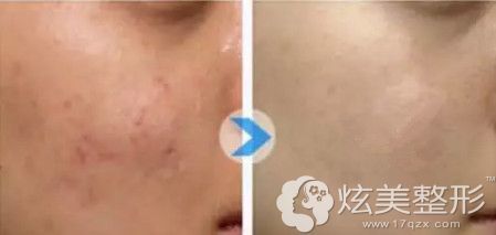 微针能不能去痘痘