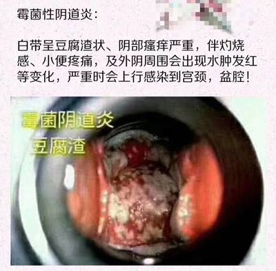霉菌会影响胎儿吗