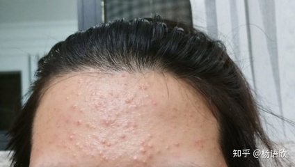 不长痘痘是什么情况