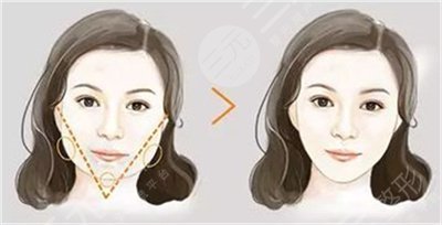 脸抽脂