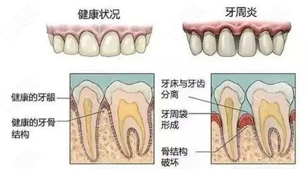 牙齿松动疼怎么治疗