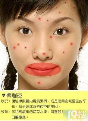 下嘴唇张痘痘是怎么回事呢