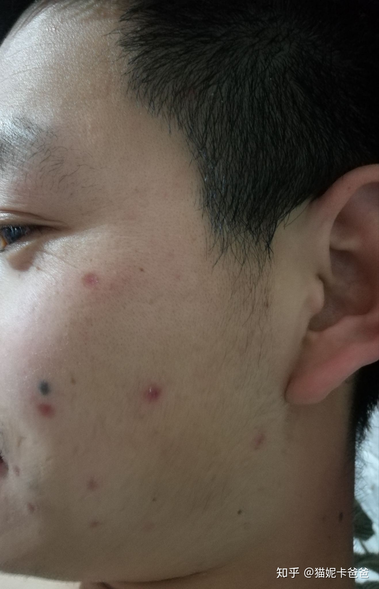 多大的痣可以用激光点