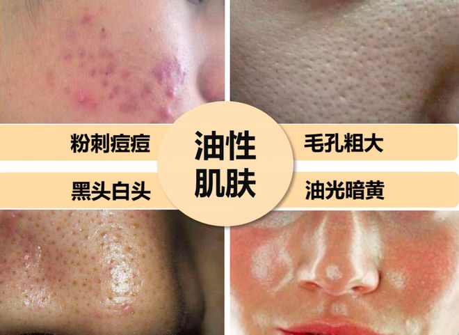痘痘后脸颊毛孔粗大怎么办