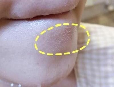 下巴经常长痘痘有白斑