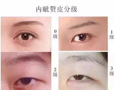 内眦赘皮双眼皮