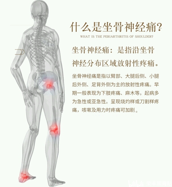 坐骨疼是怎么回事