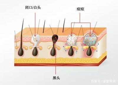 脸上痘痘疼白头怎么回事