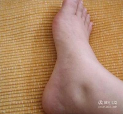 孕妇脚肿是什么原因