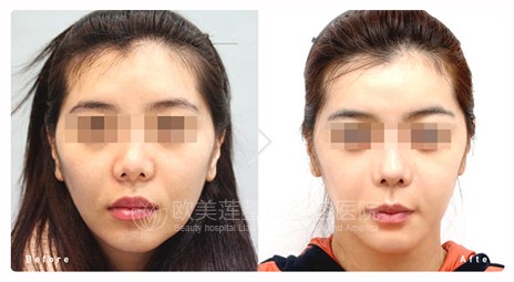 玻尿酸除皱需要多少钱