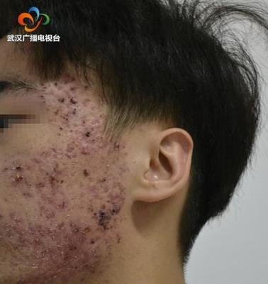 男孩青春期起痘痘