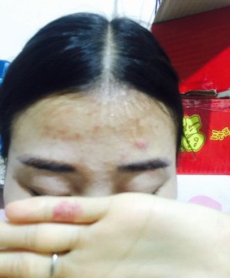脸上的痘痘忌口鸡么