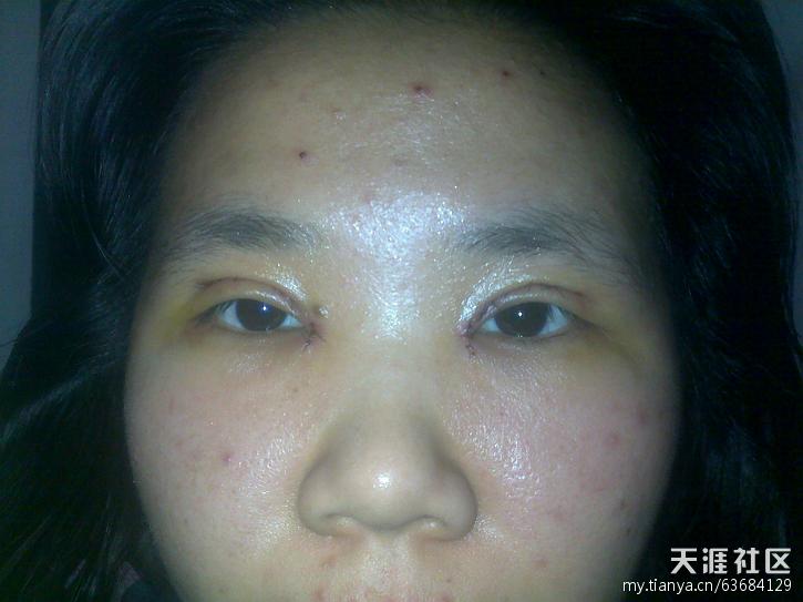双眼皮如何抽脂