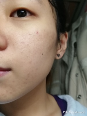 有痘痘痘印的怎么化妆