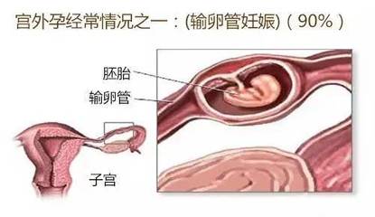 盆腔粘连能怀孕吗