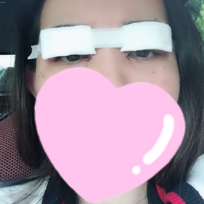 芜湖割双眼皮壹加壹优