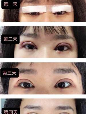 为什么眼皮很松