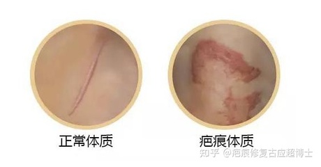 怎么判断自己是疤痕体质