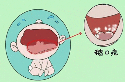 口腔溃疡怎么缓解