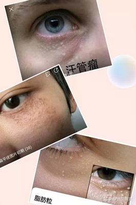眼霜涂痘痘有用吗