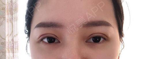 全切双眼皮照片