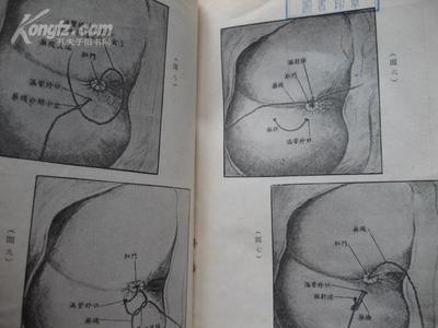 痔漏是怎么回事