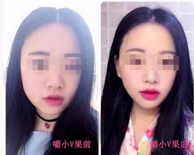 学生如何瘦双下巴和脸