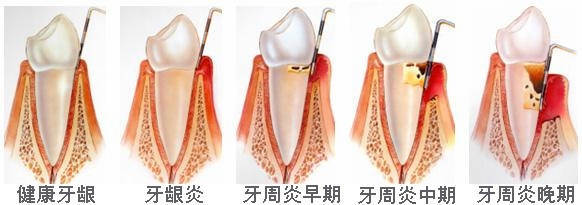 牙周炎早期怎么治疗