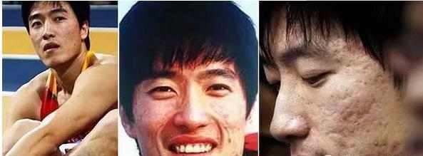 刘翔的痘痘哪里看好的