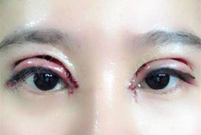 双眼皮切口处发红