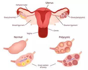 多囊会影响怀孕吗