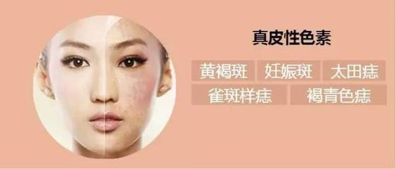 美莱激光祛斑