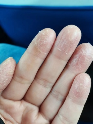 手破皮是怎么回事