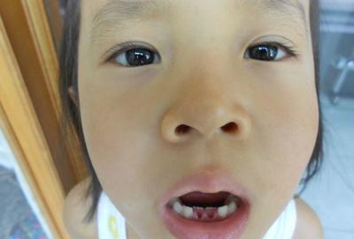 小孩怎么拔牙