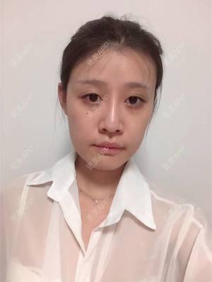 沈阳哪里打瘦脸针正规