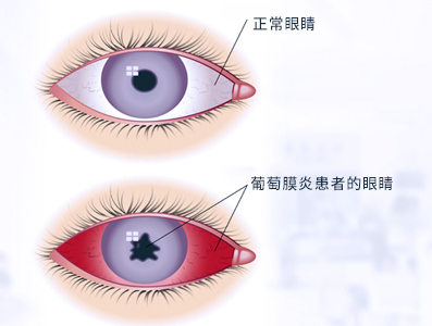 眼睛眼压高是怎么回事