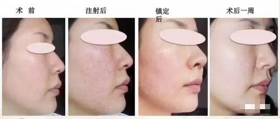 水光针能去皱纹吗