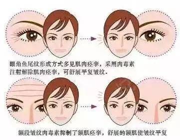 除皱原理