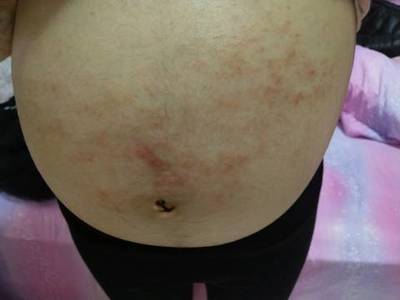 孕妇胆汁酸高有什么症状