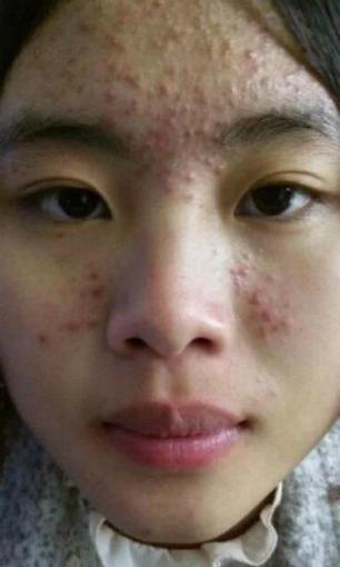 21岁男脸上长痘痘