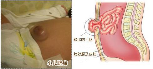 小孩疝气怎么治疗最好