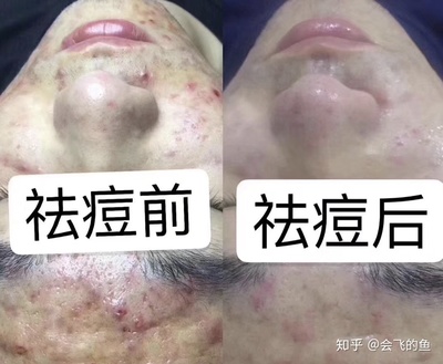 脸上的痘痘忌口鸡么
