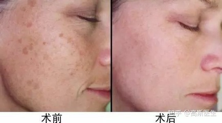 皮秒祛斑后的注意事项
