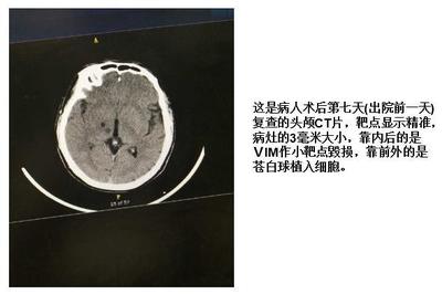 脑部腔梗怎么治疗