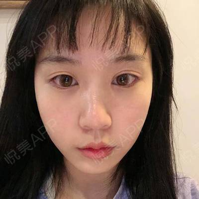 双眼皮术后多久可以洗脸