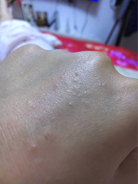 长的痘痘疼是什么原因