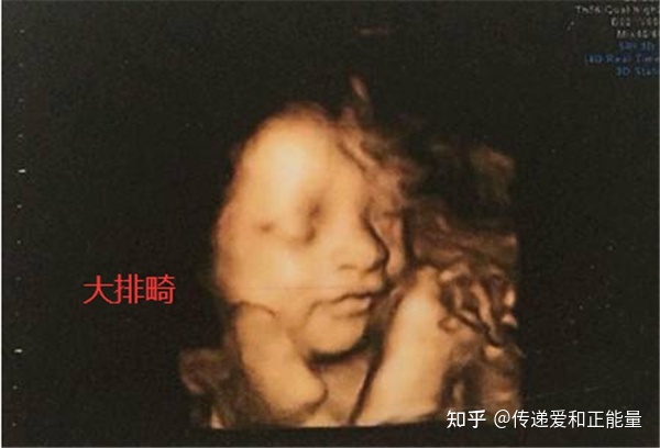 怀孕多少周可以做nt