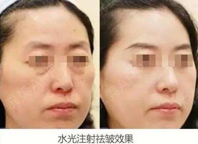 脸上长痘痘用打针